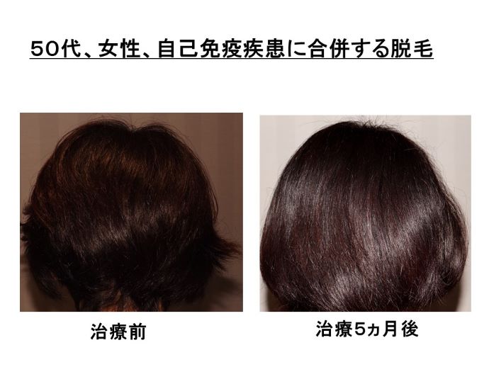 円形脱毛症　病院